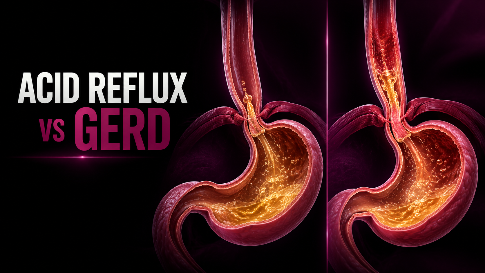 Acid Reflux vs GERD
