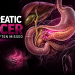Pancreatic Cancer Symptoms